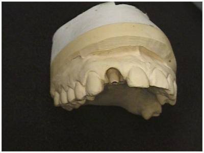 Custom Abutment (2)