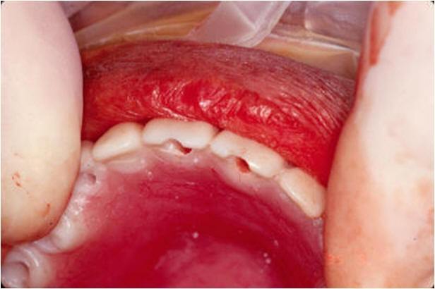 Holes in CT Appliance Used for Implant Surgery