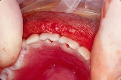 Holes in CT scan