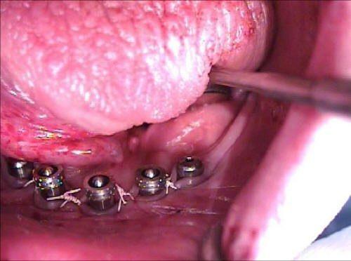 Interproximal Sutures