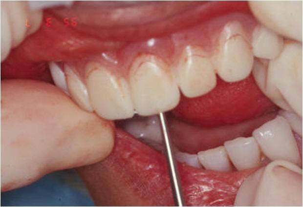 Holes in CT Appliance Used for Implant Surgery