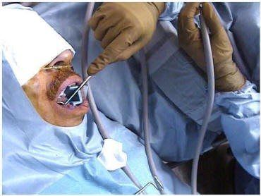 Sterile Drape Surgical Set-Up (2)