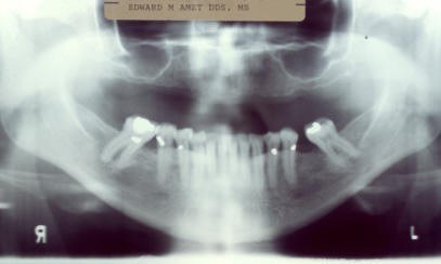 Initial Radiograph