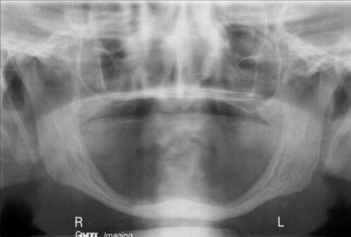 Pre-Operative Radiograph