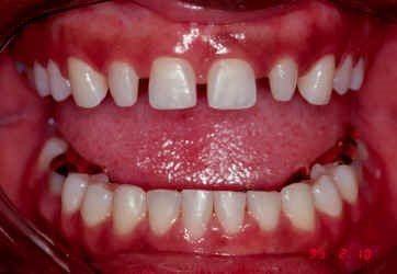Post Orthodontic