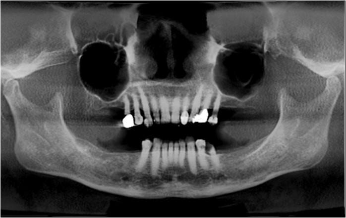 Pre-Operative Panoramic Radiograph