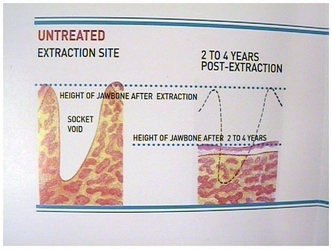 Simulated Bone Sockets(1)