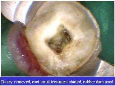 TOOTH BUILDUP (1)