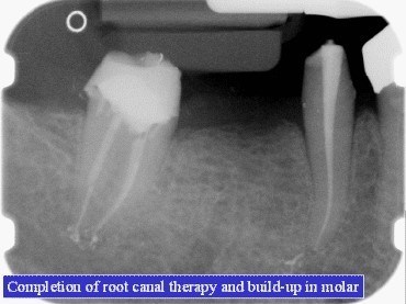 TOOTH BUILDUP (2)