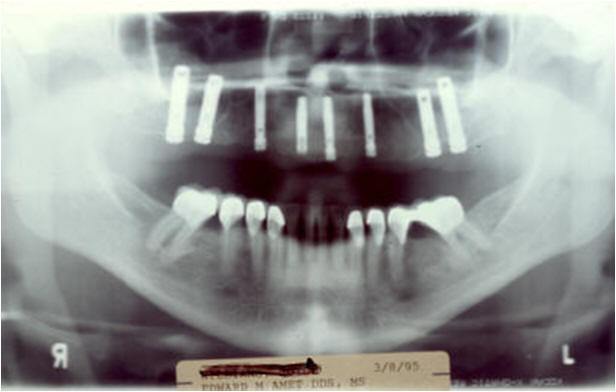 Radiograph - Two-Day Post-Op