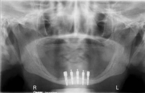 One Day Implant Placement