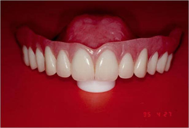 Treatment Denture Used for Planning for Aesthetics