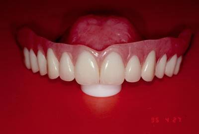 Treatment Denture