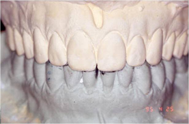 Diagnostic Mounting Used for Provisionals and Mounting