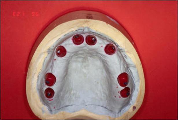 Wax-Up for Custom Abutments