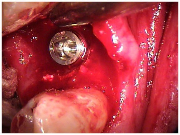 Implant Transfer