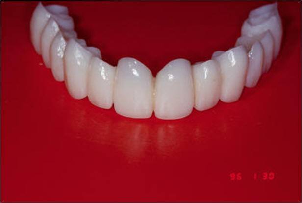 Provisionals Used During Initial Implant Loading