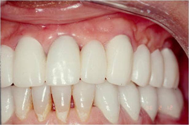 Provisionals Used During Initial Implant Loading