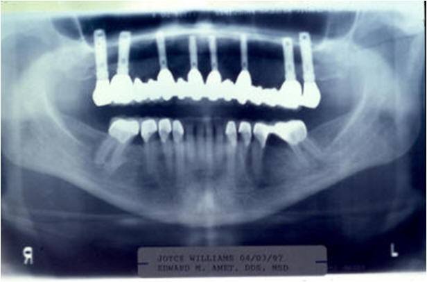 Final Radiograph