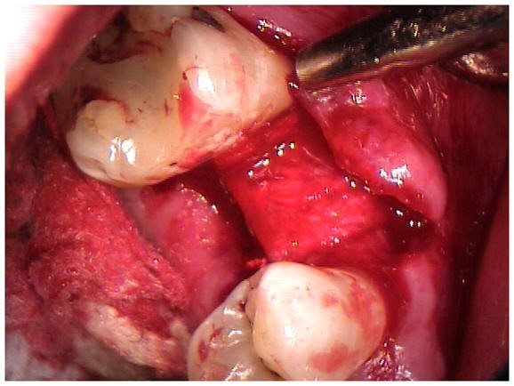 Resorbable Membrane