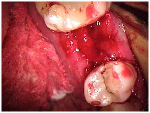 Resorbable Membrane