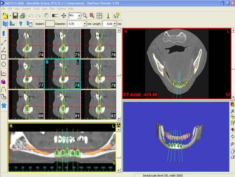 Pre-Op CT Scan Overview Study