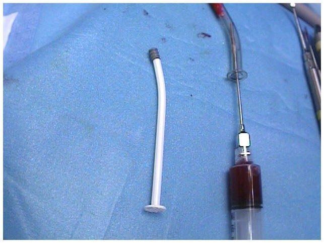 Back-Loading HTR Syringe With PRP