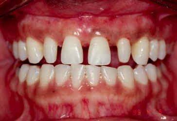 Post Orthodontic of Crown