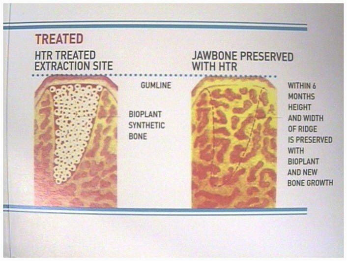 Simulated Bone Sockets(2)