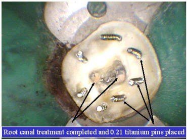 TOOTH BUILDUP (1)