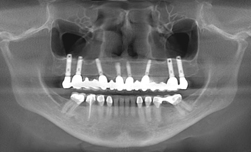 Final Radiograph