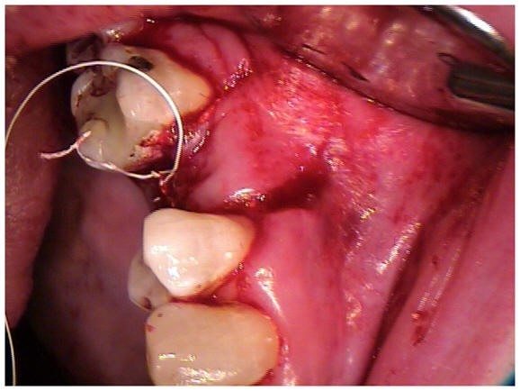 Soft Tissue Closure