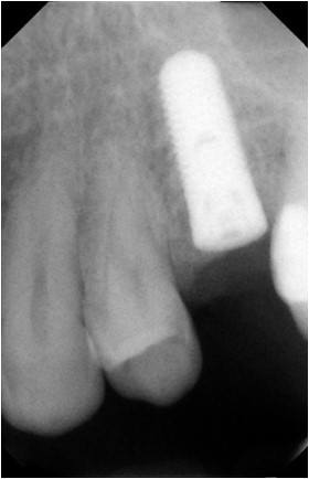 Post-Op Radiograph