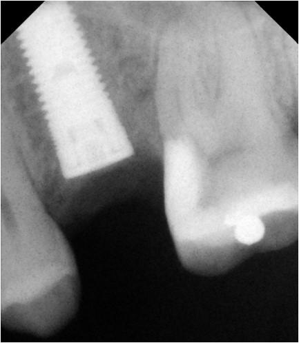 Post-Op Radiograph