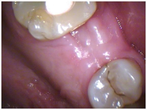 Post-Op With Increased Healthy Soft Tissue