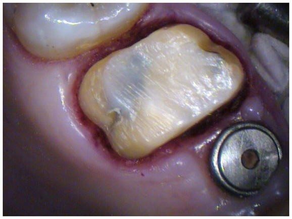 Post-Op With Crown Preparation