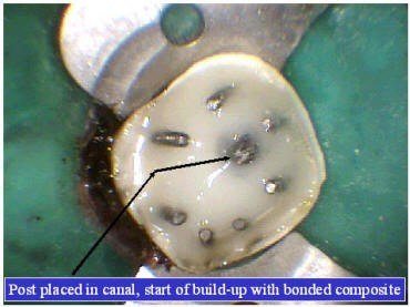 TOOTH BUILDUP (2)