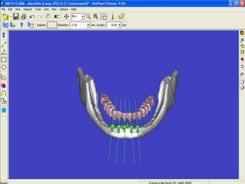  Pre-Op 3D Moveable (1)