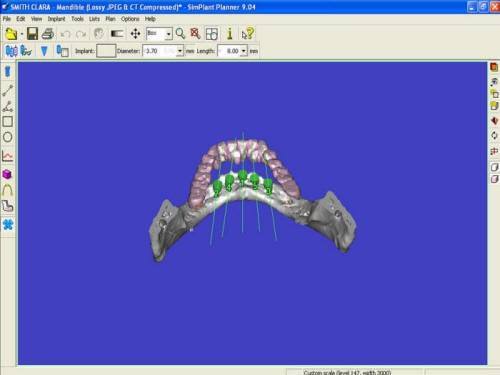  Pre-Op 3D Moveable (2)