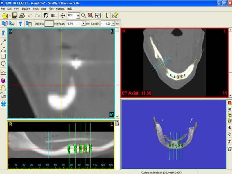 Pre-Op CT