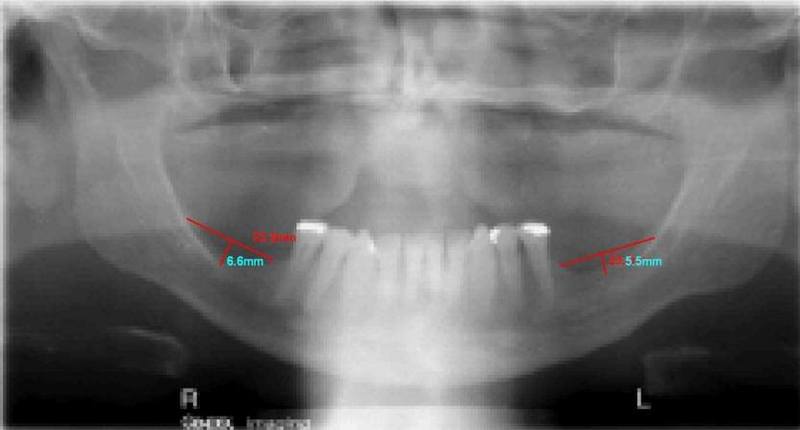 Pre-Op Radiograph