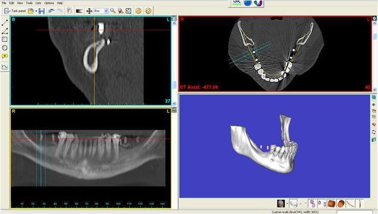 RAMUS GRAFT TO MANDIBLE