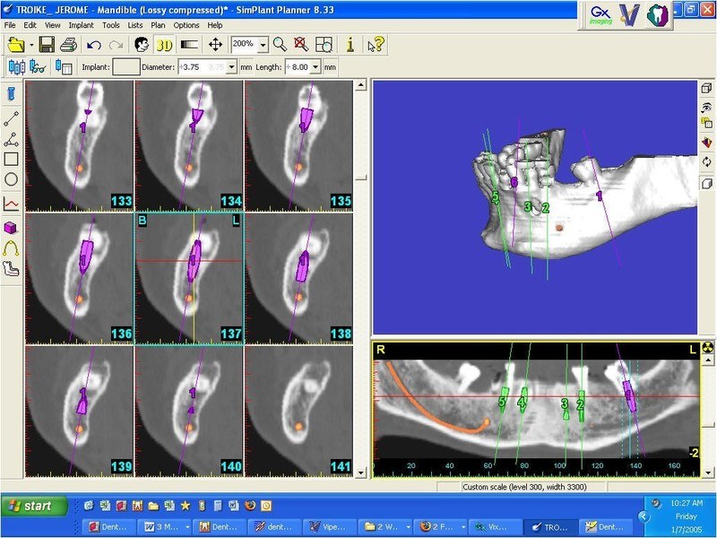 implant5