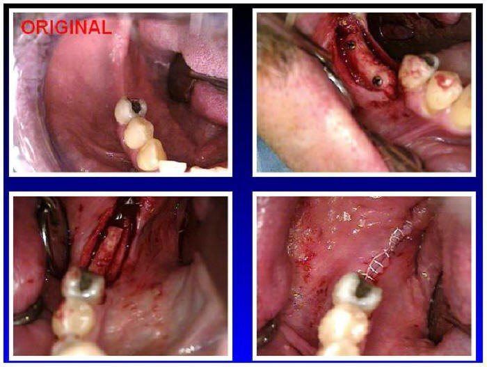 RAMUS GRAFT TO MANDIBLE