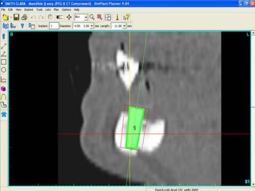  Pre-Op CT Scan