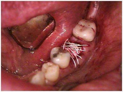 PTFE Membrane and Sutures(1)