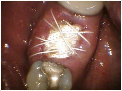 PTFE Membrane and Sutures(2)