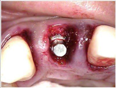  Implant Socket Graft