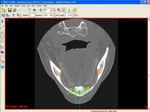 Pre-Op CT Scan