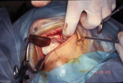 Suture Closure